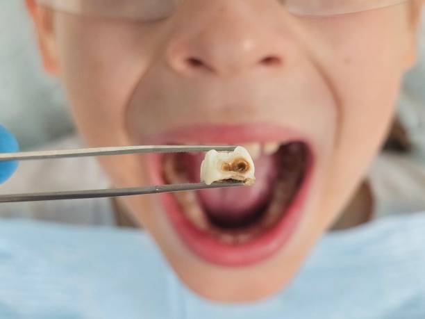 Best Emergency Root Canal Treatment in Monroe, LA